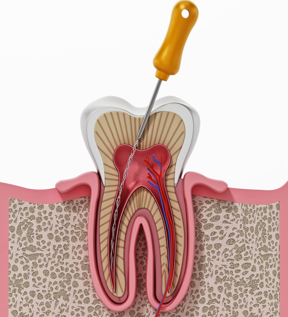 3D illustration of root canal treatment process.