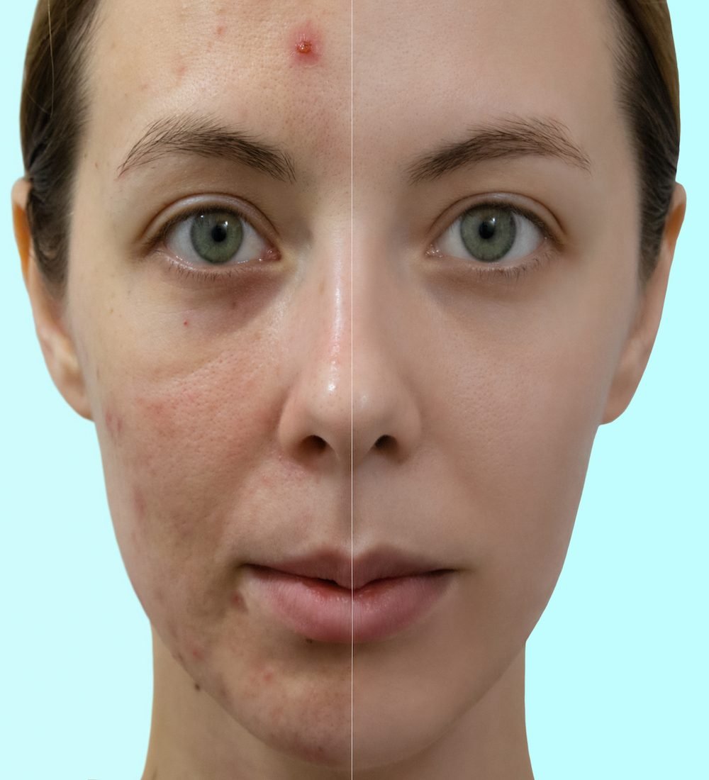 Comparison portrait of a woman with problematic skin without and with makeup.